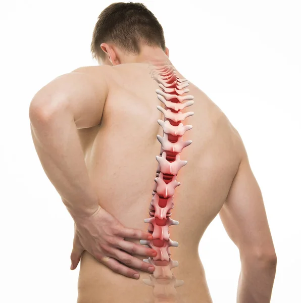 Injured Spine - Studio shot with 3D illustration isolated on whi — Stock Photo, Image
