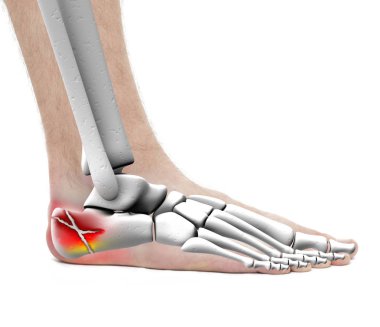 WHI üzerinde izole calcaneus kırık - anatomi erkek - Studio fotoğraf