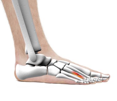Kırık Metatarsal kemik - anatomi erkek - Studio fotoğraf isol ayak