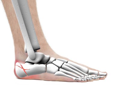 WHI üzerinde izole calcaneus kırık - anatomi erkek - Studio fotoğraf