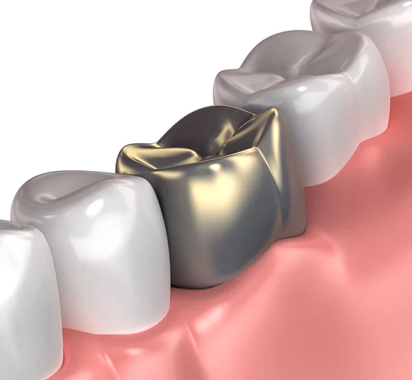 白い 3 d イラストを分離した黄金の歯口の解剖学 — ストック写真
