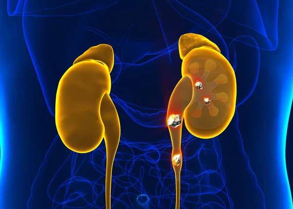 Kidney stones anatomy pain male internal organ painful cristalin — Stock Photo, Image