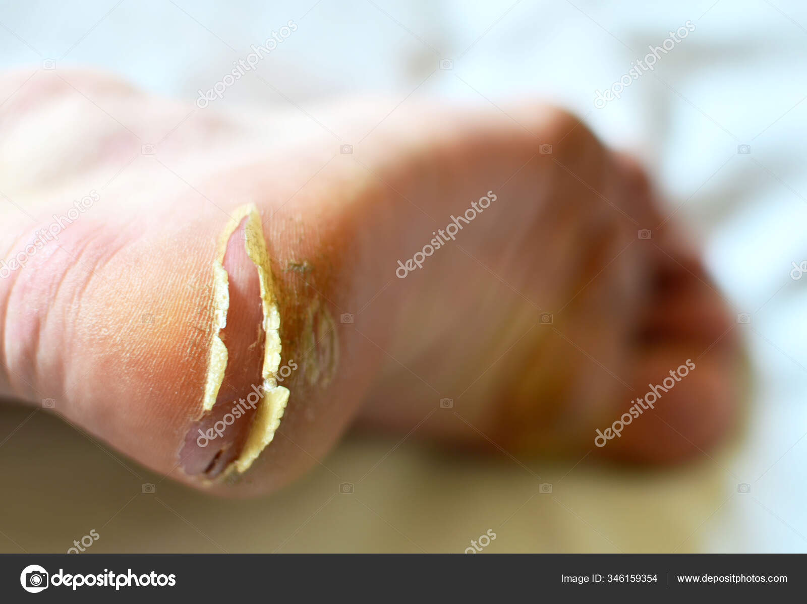 cracked calloused feet