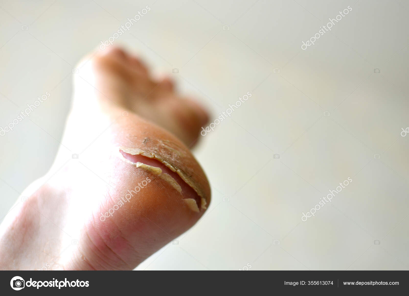 Dry Cracked Heel Callus Foot Monitor Feet Skin Condition Prevent Stock Photo Image By C Maxsafaniuk Gmail Com 355613074