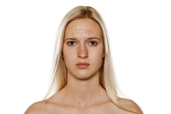 Skincare - problematic skin — Stock Photo, Image