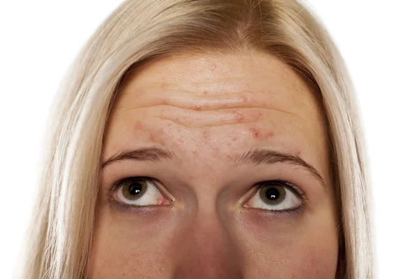 Cuidado de la piel - piel problemática —  Fotos de Stock