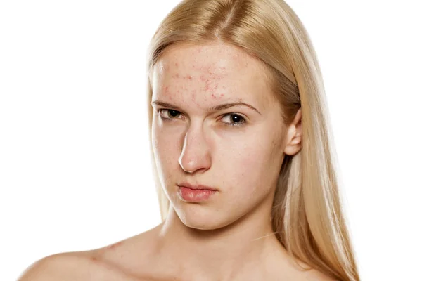 Skincare - проблемная кожа — стоковое фото