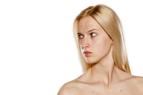 Skincare - problematic skin — Stock Photo, Image