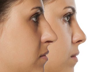 rhinoplasty before and after clipart