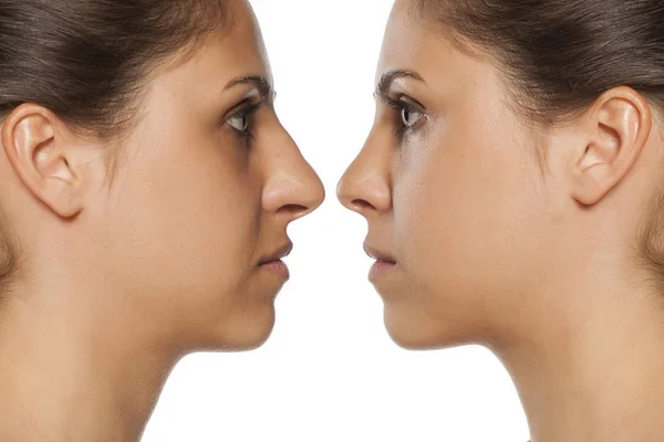 Rhinoplasty before and after — Stock Photo, Image