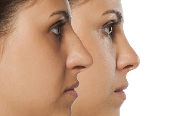 Rhinoplasty before and after — Stock Photo, Image