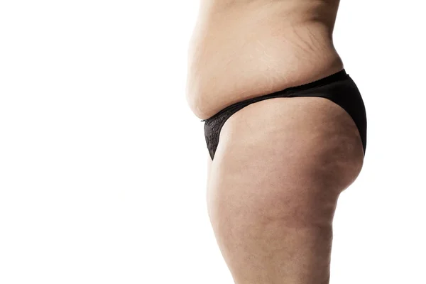 Stretch marks and cellulite — Stock Photo, Image
