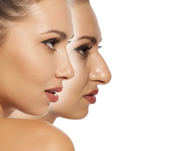 Before and after rhinoplasty — Stock Photo, Image