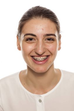 Beyaz bir arka plan üzerinde diş telleri ile genç gülümseyen kadın