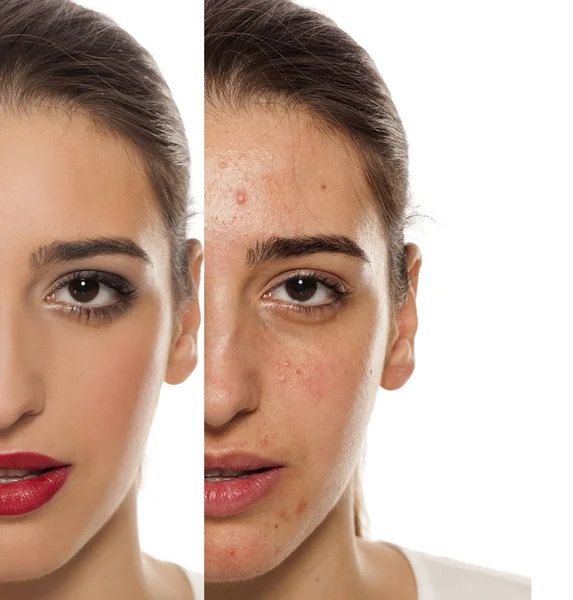 女性面孔与问题皮肤的比较画像 在化妆前后 — 图库照片