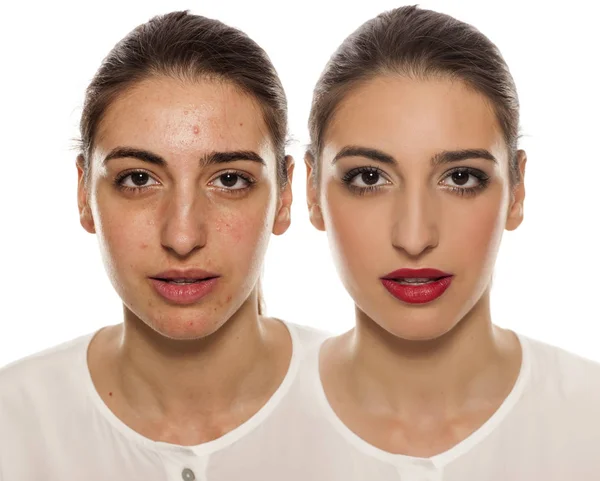 Retrato Comparativo Una Cara Femenina Con Piel Problemática Antes Después — Foto de Stock