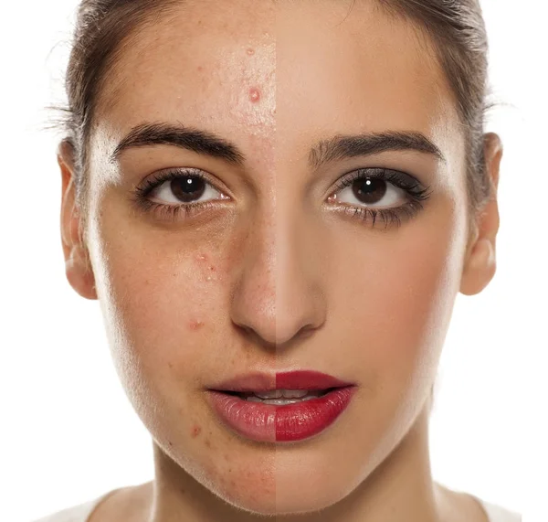 Retrato Comparativo Rosto Feminino Com Pele Problemática Antes Depois Maquilhagem — Fotografia de Stock
