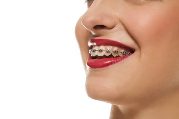 Wanita Muda Tersenyum Dengan Kawat Gigi Latar Belakang Putih — Stok Foto
