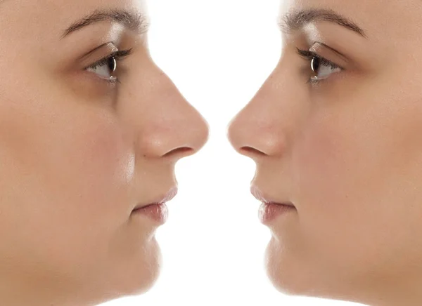 Foto Perbandingan Seorang Wanita Muda Sebelum Dan Sesudah Operasi Hidung — Stok Foto