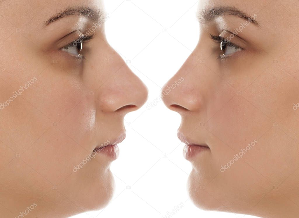 Comparative portrait of a young woman before and after nose surgery