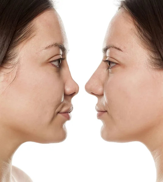 Perfil Mujer Antes Después Cirugía Nariz —  Fotos de Stock