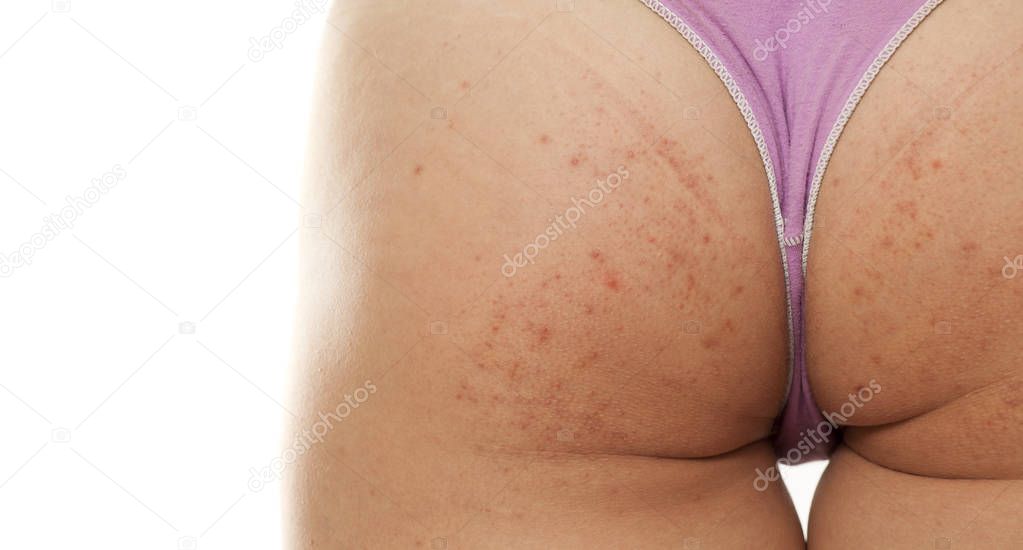 Woman's buttocks with problematic skin on a white background