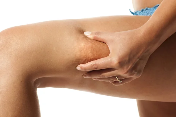 Young Woman Pinching Cellulite Her Leg White Background — Stock Photo, Image