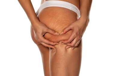 woman squeezing the cellulite on her butt on white background