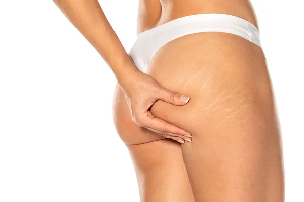 Woman Pinching Stretch Marks Her Bottom — Stock Photo, Image