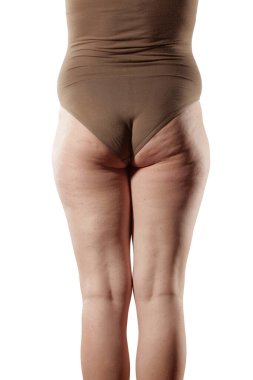 Obez kadınların ve selülitlerin bacakları ve kalçaları