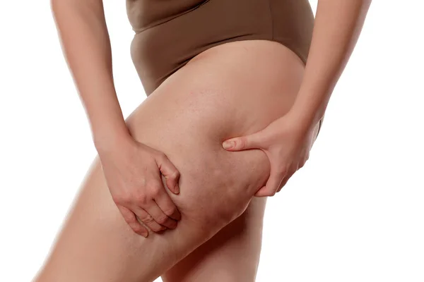 Dikke Vrouw Knijpen Haar Been Tonen Cellulitis — Stockfoto