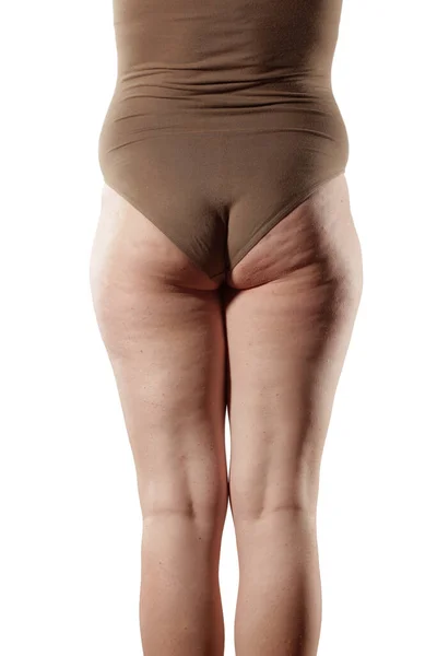 Nohy Hýždě Obézních Žen Celulitidy — Stock fotografie