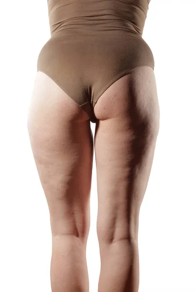 Legs Buttocks Obese Women Cellulite — Stock Photo, Image