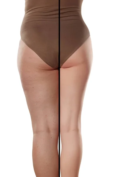 Comparison Female Legs Cellulite Fat — Stock Photo, Image