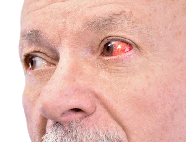 Homme âgé avec un oeil irrité de sang rouge — Photo