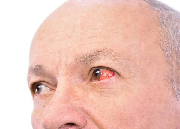 Senior man with irritated red bloodshot eye — Stock Photo, Image