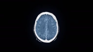 İnsan beyin MRI tarama