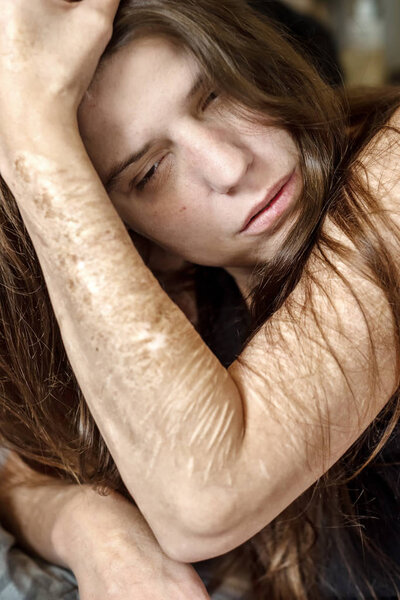 Портрет и рука женщины с порезами и шрамами от самоувечья в разочаровании, самоистязании, пограничном расстройстве личности
,