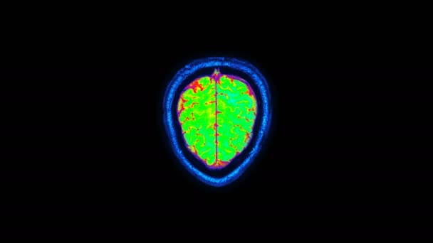 Resonancia magnética Tomografía por resonancia magnética de una disfunción cerebral humana, áreas problemáticas. El lapso de tiempo. Radiografía, tomografía médica computarizada. Cámara infrarroja RGB — Vídeo de stock