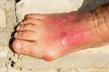 Deri yanığı sonucu, kadının bacağı ayak bileği bölgesinde şişmiş. Dermatit, kızarıklık, soyulma ve güneş banyosundan sonra ağrı ile ifade edilir. Ayaklarım ağrıyor..