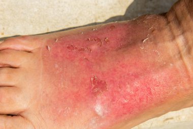 Deri yanığı sonucu, kadının bacağı ayak bileği bölgesinde şişmiş. Dermatit, kızarıklık, soyulma ve güneş banyosundan sonra ağrı ile ifade edilir. Ayaklarım ağrıyor..