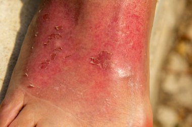 Deri yanığı sonucu, kadının bacağı ayak bileği bölgesinde şişmiş. Dermatit, kızarıklık, soyulma ve güneş banyosundan sonra ağrı ile ifade edilir. Ayaklarım ağrıyor..
