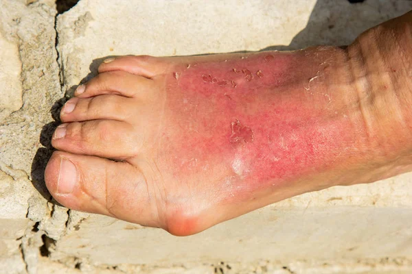 Aufgrund einer Hautverbrennung war das Bein der Frau im Bereich des Knöchels angeschwollen. Dermatitis, ausgedrückt durch Rötung, Peeling und Schmerzen nach dem Sonnenbad. Wunde Fußprellung. — Stockfoto