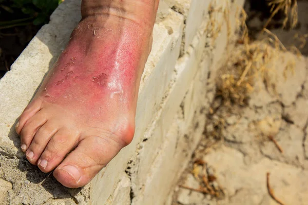 Als gevolg van een brandwond aan de huid, was het been van de vrouw gezwollen in het enkelgebied. Dermatitis, uitgedrukt in roodheid, schilfering en pijn na het zonnebaden. Pijnlijke voetbult. — Stockfoto