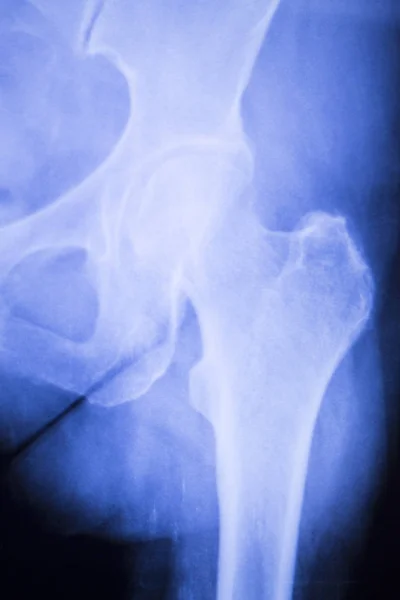 髋关节疼痛骨科植入物的 x 射线 — 图库照片