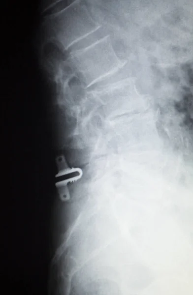 Wervelkolom orthopedie spinale implantaat xray — Stockfoto