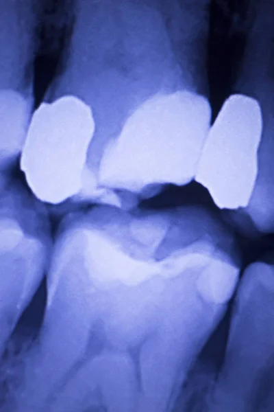 Dentistas dientes dentales rayos X — Foto de Stock