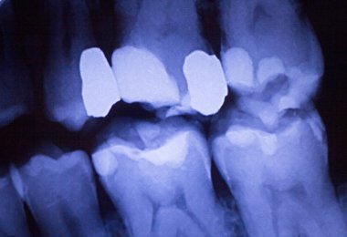 Diş hekimleri diş diş xray