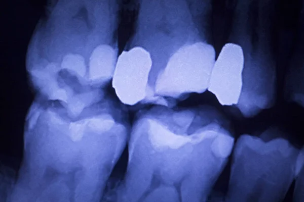 Dentysta dentystyczny zęby xray — Zdjęcie stockowe