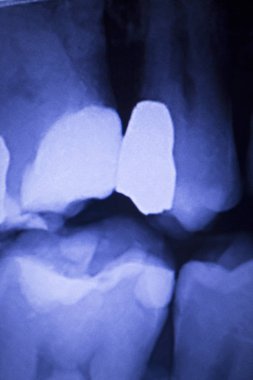 Diş hekimleri diş diş xray